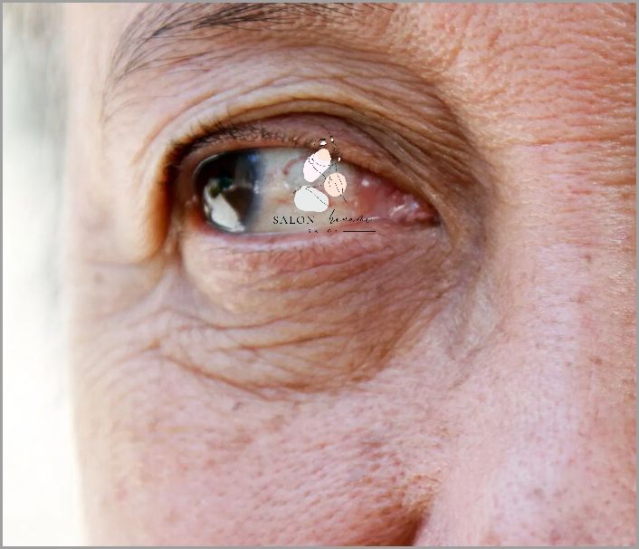 Jak Pozbyć Się Czerwonej Skóry Pod Oczami? Jak Pozbyć Się Czerwonej Skóry Pod Oczami?