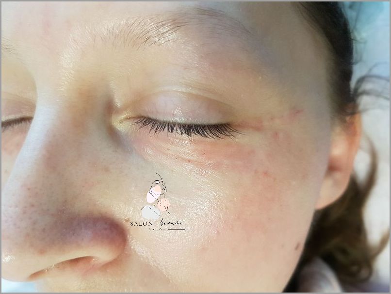 Jak Pozbyć Się Czerwonej Skóry Pod Oczami? Jak Pozbyć Się Czerwonej Skóry Pod Oczami?