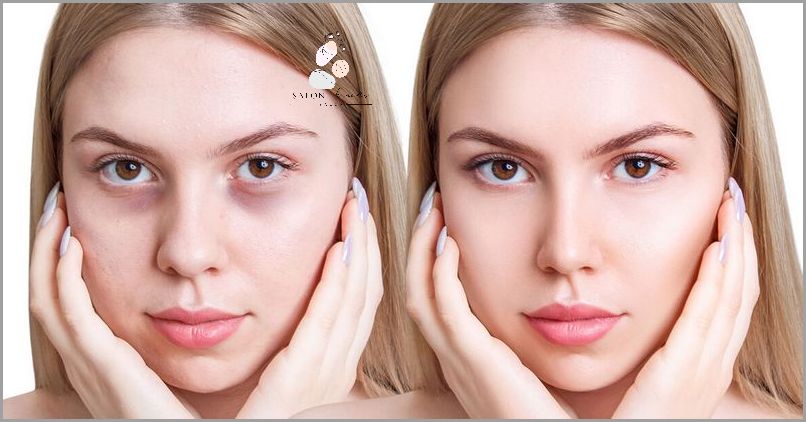 Jak Pozbyć Się Czerwonej Skóry Pod Oczami? Jak Pozbyć Się Czerwonej Skóry Pod Oczami?