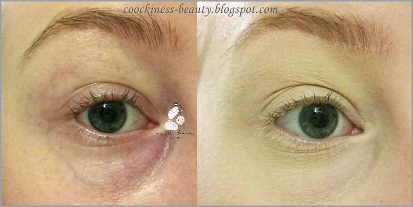 Jak Pozbyć Się Czerwonej Skóry Pod Oczami? Jak Pozbyć Się Czerwonej Skóry Pod Oczami?