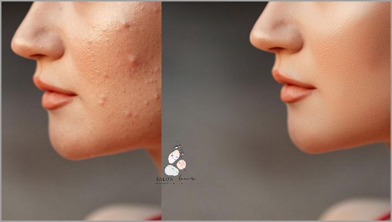 Jak Wyciskać Pryszcze Na Nosie?