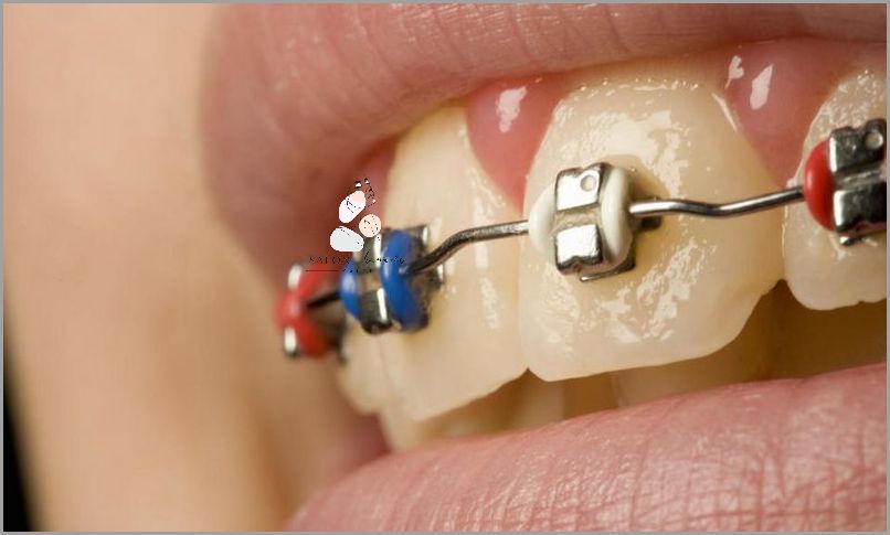 Kolory Gumek Do Aparatu: Przepiękny Wybór!