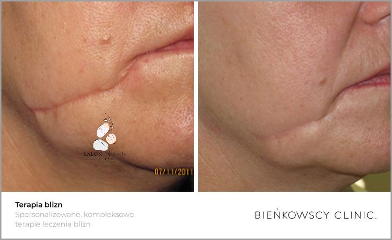 Laser Frakcyjny Dzień Po Dniu - Sprawdź, Co Się Stało!