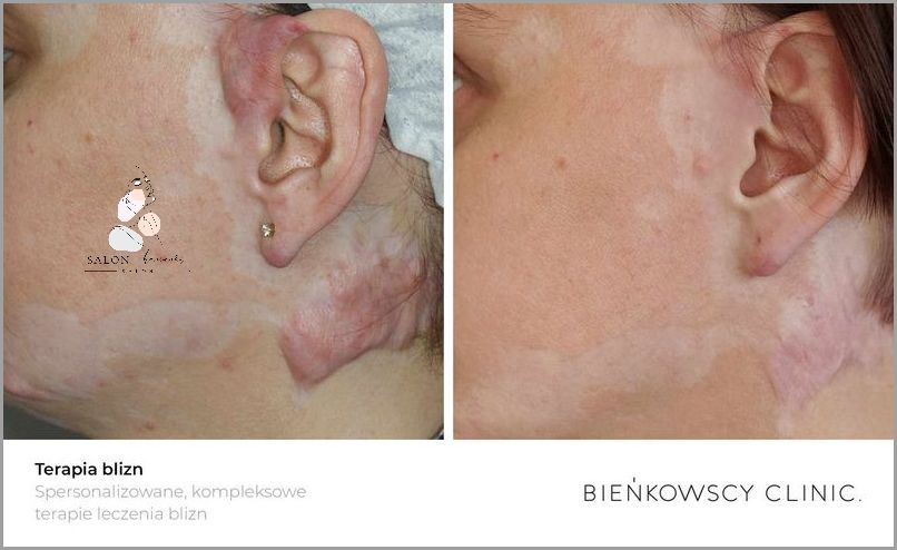 Laser Frakcyjny Dzień Po Dniu - Sprawdź, Co Się Stało!