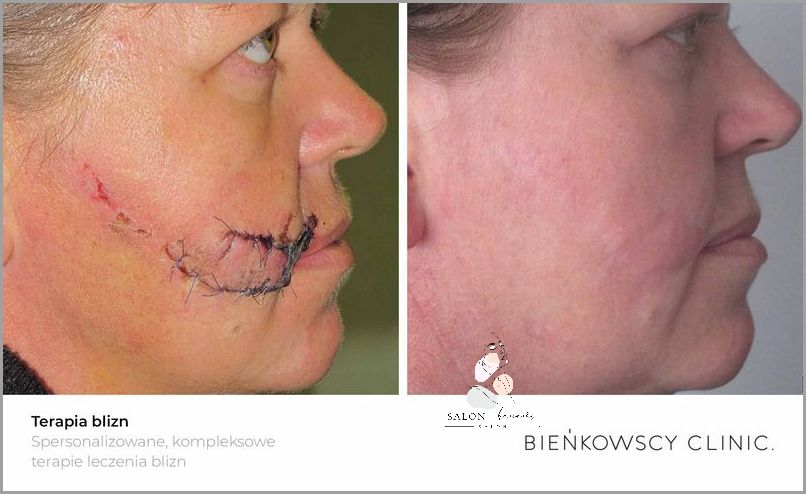 Laser Frakcyjny Dzień Po Dniu - Sprawdź, Co Się Stało!