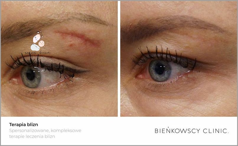 Laser Frakcyjny Dzień Po Dniu - Sprawdź, Co Się Stało!