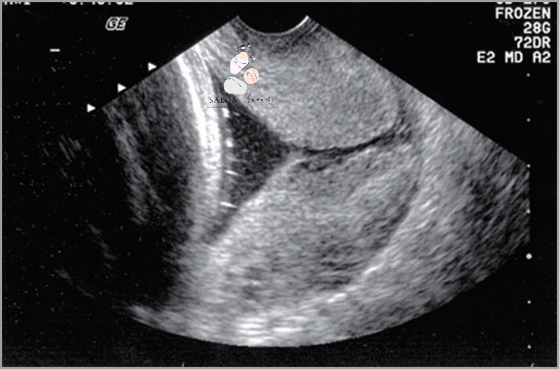Niebezpieczeństwo: Skrócona Szyjka Macicy W Ciąży!