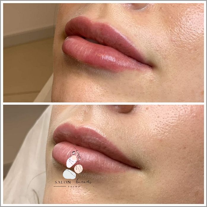 Niesamowite Efekty Powiększania Ust Metodą Russian Lips!