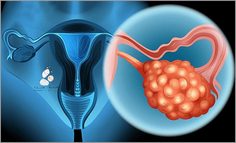 Objawy Pęknięcia Torbieli Jajnika - Ostrzeżenie!