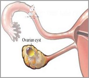 Objawy Pęknięcia Torbieli Jajnika - Ostrzeżenie!