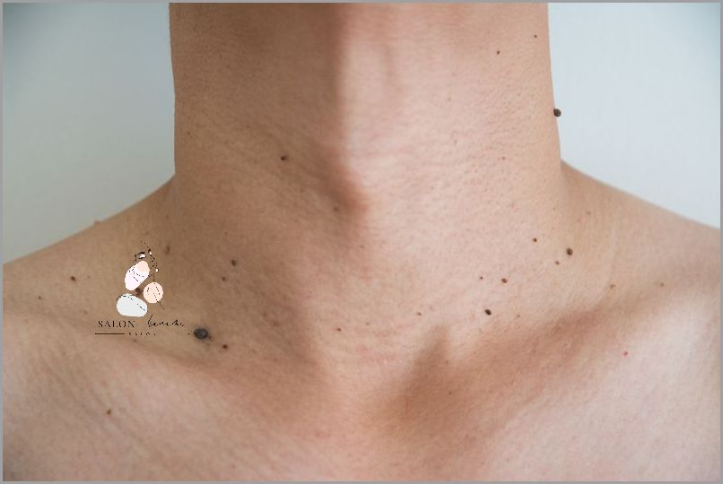 Odkryj Domowe Sposoby Na Włókniaki!