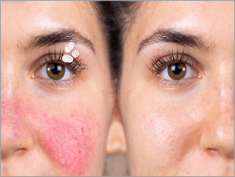 Odkryj Przyczyny Przebarwień Na Twarzy!