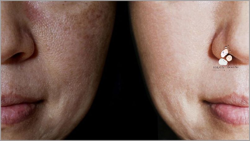 Odkryj Przyczyny Przebarwień Na Twarzy!