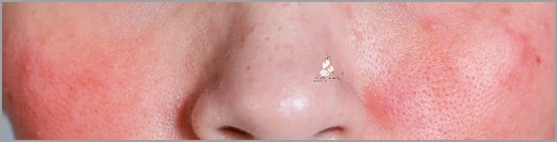 Odkryj Przyczyny Przebarwień Na Twarzy!