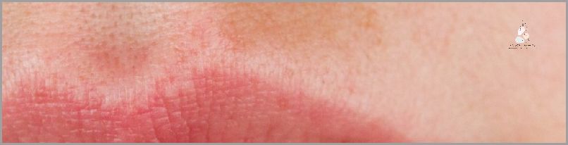 Oparzenia Słoneczne: Pierwsza Pomoc, której NIE MOŻESZ pominąć!