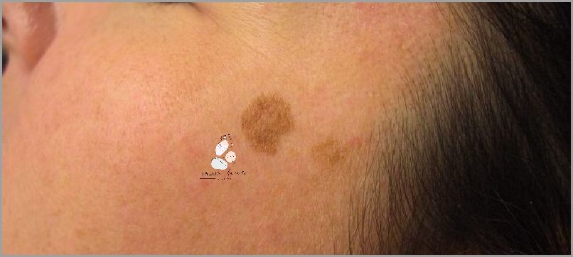 Oparzenia Słoneczne: Pierwsza Pomoc, której NIE MOŻESZ pominąć!