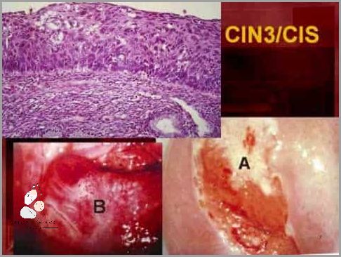 Sensacyjne Leczenie Lsil Hpv Cin 1! Sensacyjne Leczenie Lsil Hpv Cin 1!