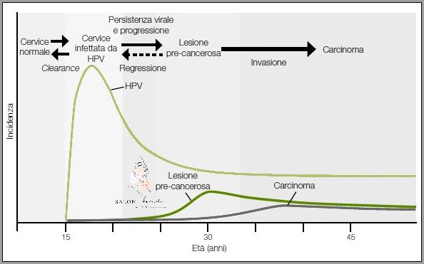 Sensacyjne Leczenie Lsil Hpv Cin 1! Sensacyjne Leczenie Lsil Hpv Cin 1!
