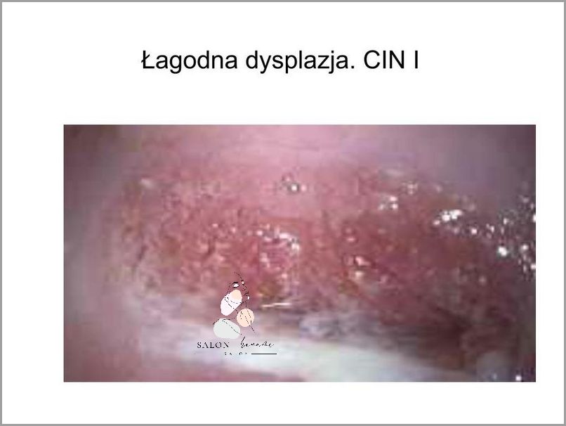 Sensacyjne Leczenie Lsil Hpv Cin 1! Sensacyjne Leczenie Lsil Hpv Cin 1!