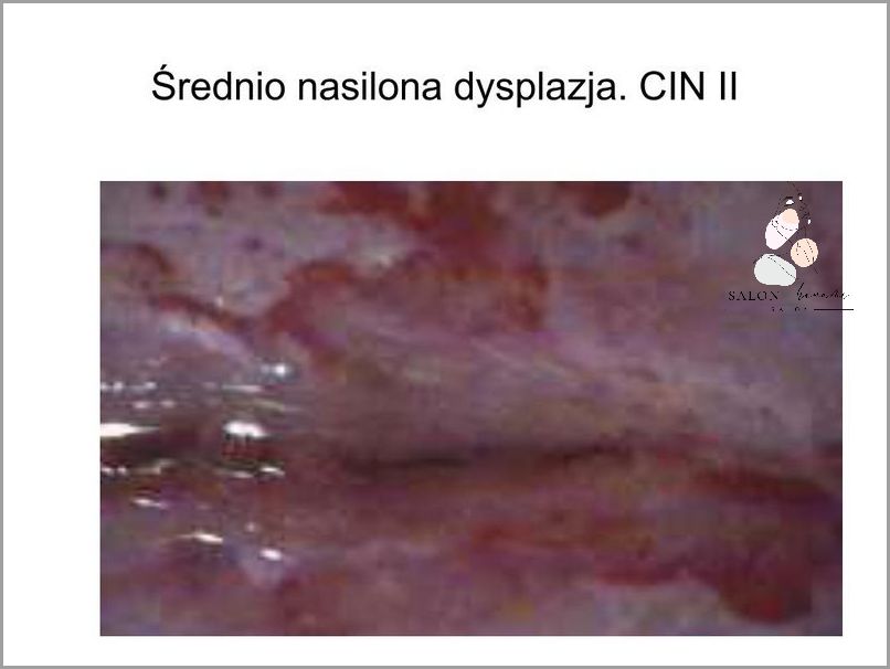 Sensacyjne Leczenie Lsil Hpv Cin 1! Sensacyjne Leczenie Lsil Hpv Cin 1!