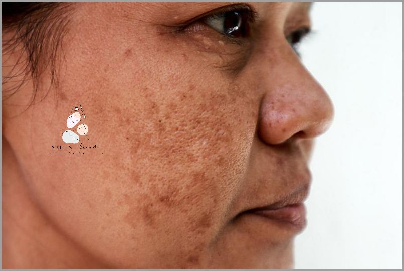 Uratuj Się Przed Brązowymi Plamkami Na Twarzy!