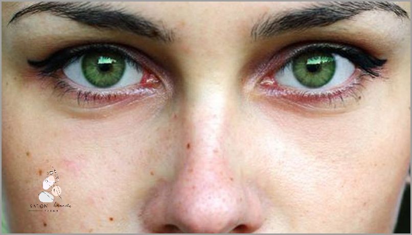 Uratuj Się Przed Brązowymi Plamkami Na Twarzy!