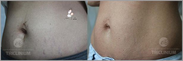 Zabiegi na Obwisłą Skórę Na Brzuchu!