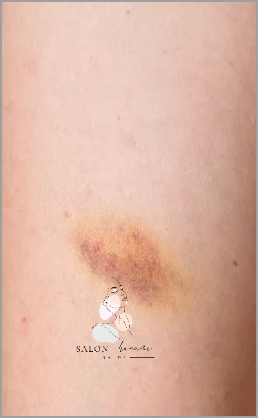Zdjęcia Zmian Skórnych Na Pośladkach! Zdjęcia Zmian Skórnych Na Pośladkach!