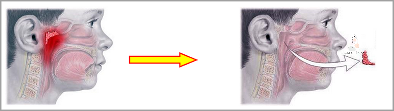 Efekty Rekonwalescencji Po Usunięciu Trzeciego Migdałka U Dziecka!