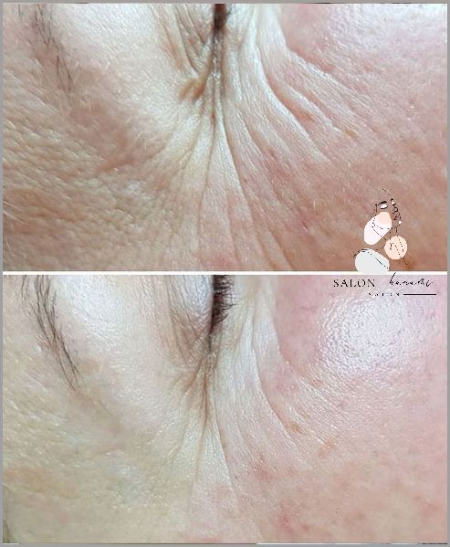 Retinol Przed I Po - Zobacz Zaskakujące Efekty! Retinol Przed I Po - Zobacz Zaskakujące Efekty!