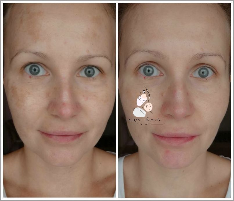 Retinol Przed I Po - Zobacz Zaskakujące Efekty! Retinol Przed I Po - Zobacz Zaskakujące Efekty!