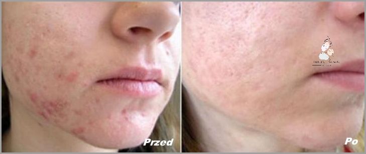 Retinol Przed I Po - Zobacz Zaskakujące Efekty! Retinol Przed I Po - Zobacz Zaskakujące Efekty!
