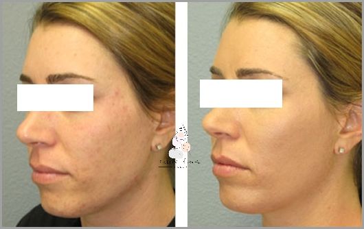 Retinol Przed I Po - Zobacz Zaskakujące Efekty! Retinol Przed I Po - Zobacz Zaskakujące Efekty!