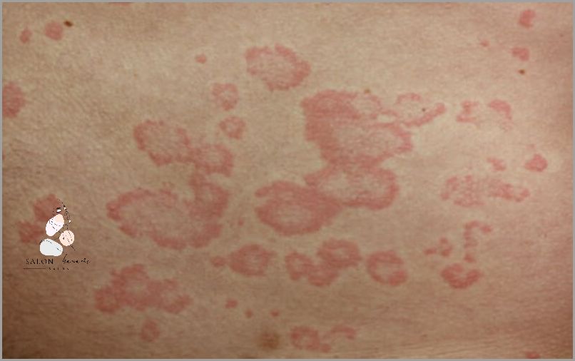 Uczucie Pieczenia: Czerwone Krosty Na Plecach!