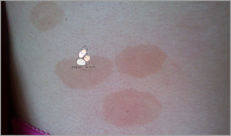 Uczucie Pieczenia: Czerwone Krosty Na Plecach!