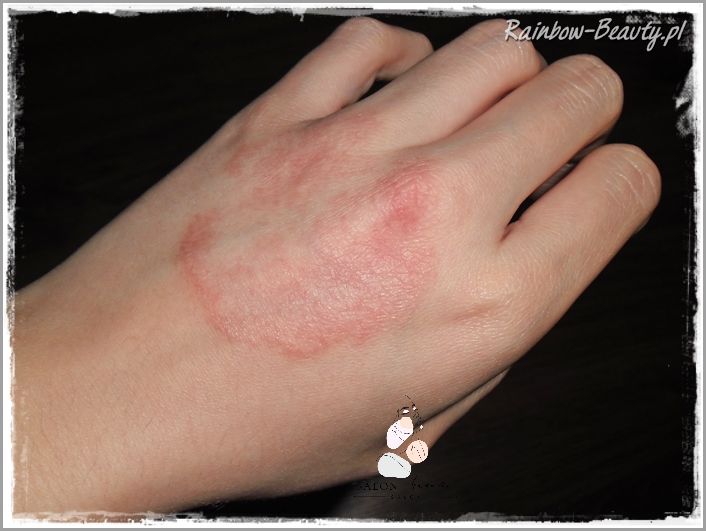 Uczucie Pieczenia: Czerwone Krosty Na Plecach!