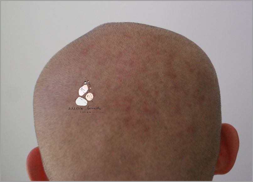 Uczucie Pieczenia: Czerwone Krosty Na Plecach!