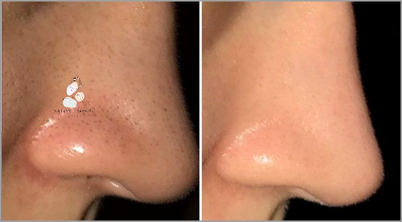 Uderzyłeś się i masz Siniak na Nosie?!