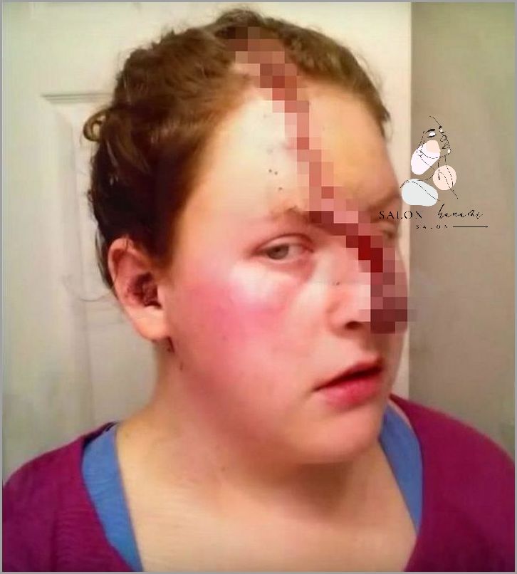 Uderzyłeś się i masz Siniak na Nosie?!