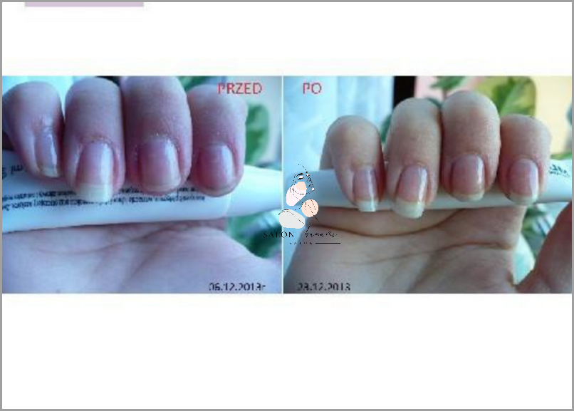 Ujawniamy Efekty Stosowania Regenerum Do Paznokci!