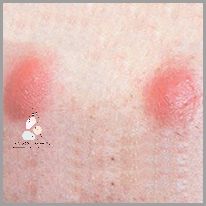 Uwaga: Duży Pryszcz Na Plecach!