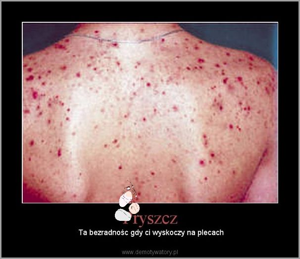 Uwaga: Duży Pryszcz Na Plecach!