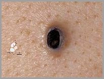 Uwaga: Duży Pryszcz Na Plecach!