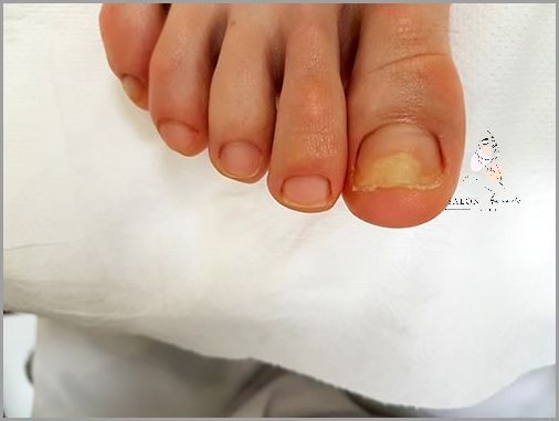 Uwaga! Zielona Bakteria Na Paznokciu!