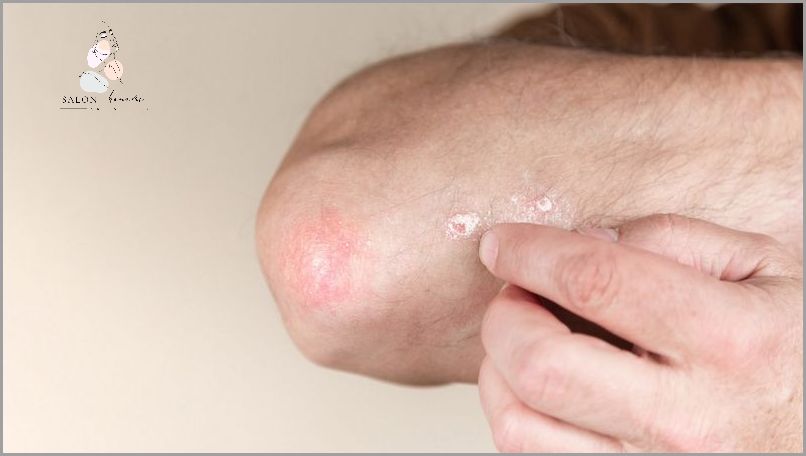 Zobacz Zdjęcia Atopowego Zapalenia Skóry Wokół Oczu!