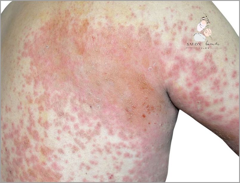 Zobacz Zdjęcia Atopowego Zapalenia Skóry Wokół Oczu!