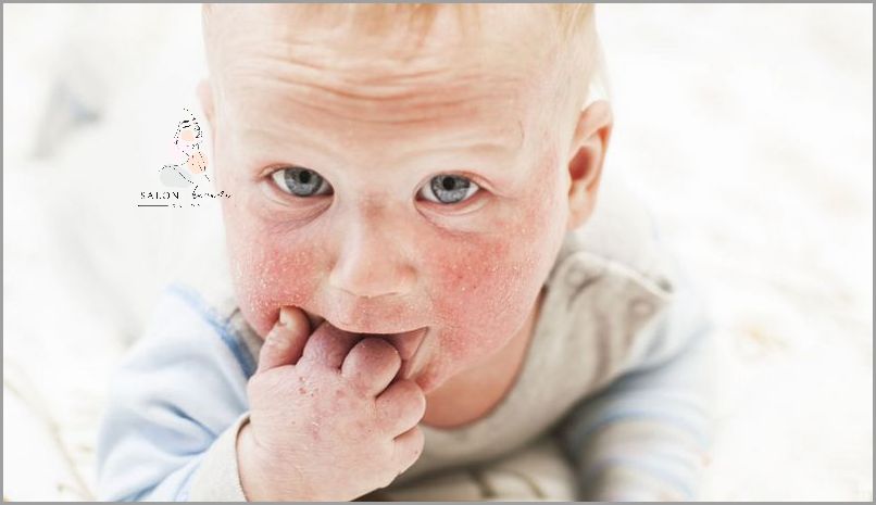 Zobacz Zdjęcia Atopowego Zapalenia Skóry Wokół Oczu!