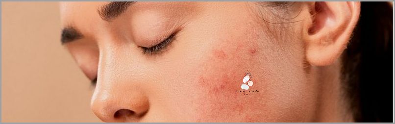 Zobacz Zdjęcia Atopowego Zapalenia Skóry Wokół Oczu!