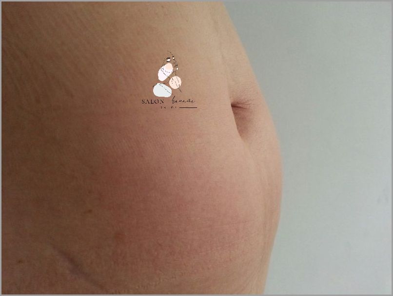 Przełomowe Zabiegi Na Brzuch Po Ciąży!