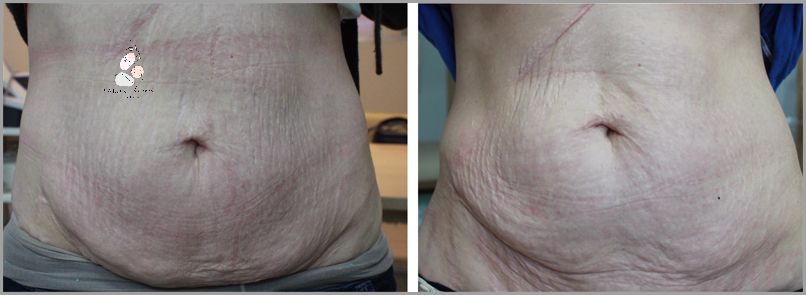 Przełomowe Zabiegi Na Brzuch Po Ciąży!